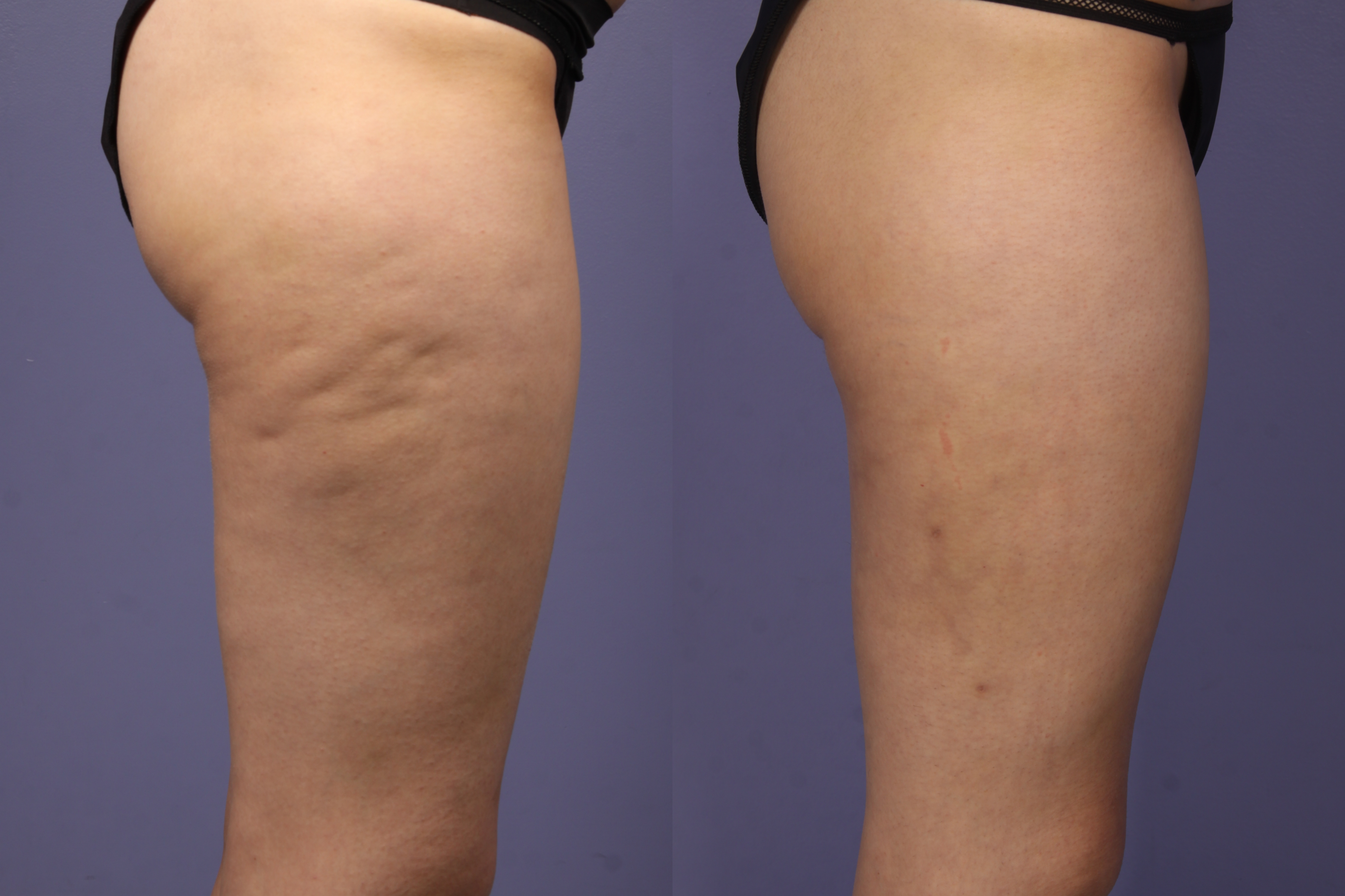 cellulite